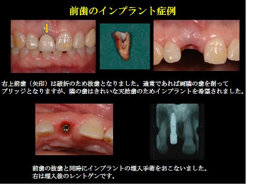 インプラント①